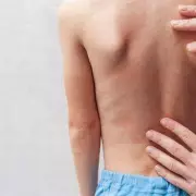 Measles Alert: UKHSA Warns of Virus 'Twice as Contagious as Common Cold'