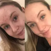 Acne Hack: The £1.50 Spot Treatment That's Going Viral