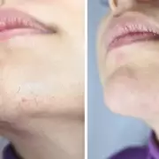 Keskine IPL Handset £140 Off: 'Best Hair Removal' Reviews & Black Friday Deal