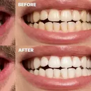 Amazon Deal: Nab 'Best Teeth Whitening Strips Ever' for Just £8.49