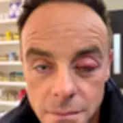 Ant McPartlin's Eye Swelling Drama: TV Star Reveals Blocked Tear Duct