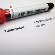 Birmingham Establishes Specialist Board to Combat Rising Tuberculosis Cases