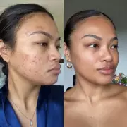 Boots £11 Spot Cream Sparks 'Wow' Face Transformations for Acne-Prone Skin