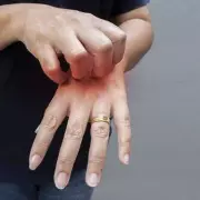 Poinsettia Warning: Popular Festive Plant Can Cause Painful Skin Rashes