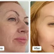 Save £400 on LED Face Mask with 80% Off Partner Deal