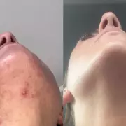 From Recluse to Confident: How a Skincare Staple Transformed a Woman's Life