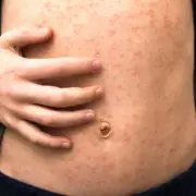 Measles Outbreak Hospitalizes Children in London Schools