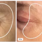 Red Light Therapy Eye Mask Garners Praise for Anti-Ageing Results