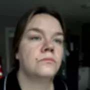 Walsall Mother Awarded £10,000 Compensation After Dental Procedure Causes Facial Burn