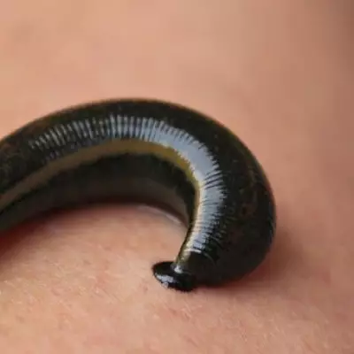 Birmingham Clinic Pioneers Leech Therapy for Modern Wellbeing and Health