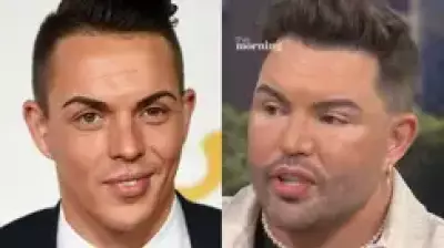 Bobby Norris Reveals Real Reason for Facelift in Emotional Interview