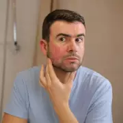 NHS Issues Sunburn Advice After 30C Bank Holiday Weekend