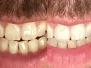 Man, 66, says £10 powder removed coffee and beer stains from teeth
