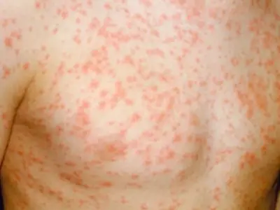 Birmingham Parents Warned as West Midlands Has Second Highest Measles Cases