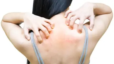 NHS issues heat rash advice: symptoms and simple treatments for prickly heat