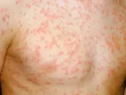 Birmingham Parents Warned as West Midlands Has Second Highest Measles Cases