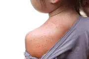Measles Cases Rise in West Midlands: How Your Family Can Get Protected