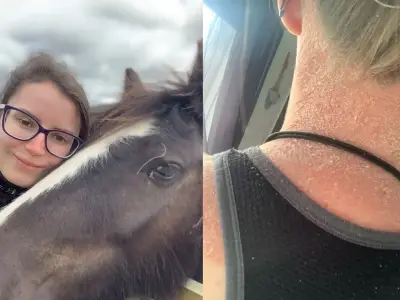 NHS worker's psoriasis 'torture' ends after £11 Amazon buy