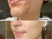£30 Gel Helps Acne Sufferers Go Makeup-Free, Shoppers Say